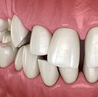 Illustration of gapped teeth