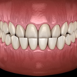 Illustration of an underbite