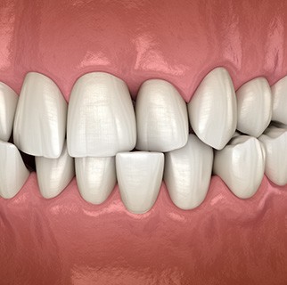 Illustration of a crossbite