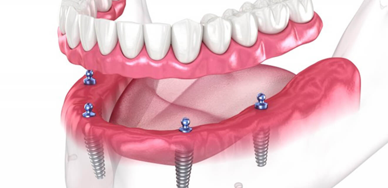 a 3D illustration of all-on-4 dental implants